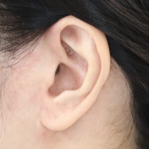 新宿ラクル美容外科クリニック　山本厚志　ナチュラルフェイスネックリフト　耳の傷痕　　手術前　　１２月１２日