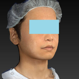 新宿ラクル美容外科クリニック　山本厚志　「アルテミスリフト＋ライポライフ脂肪吸引（メーラーファット+ジョールファット）」　手術前　１２月１５日