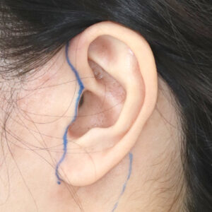 新宿ラクル美容外科クリニック　山本厚志　ナチュラルフェイスネックリフト　耳の傷痕　　デザイン　　１２月１２日