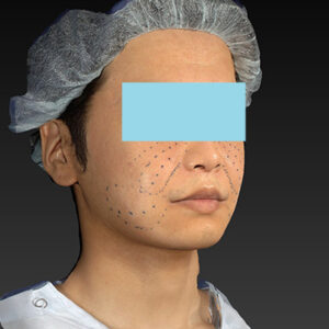 新宿ラクル美容外科クリニック　山本厚志　「アルテミスリフト＋ライポライフ脂肪吸引（メーラーファット+ジョールファット）」　デザイン　１２月１５日