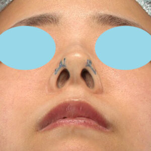 「鼻孔縁下降術」　新宿ラクル美容外科クリニック　山本厚志　３０代女性　デザイン　１月３日