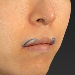 新宿ラクル美容外科クリニック　山本厚志　「外側人中短縮術（上口唇挙上術）修正 + 口角挙上（スマイルリフト）修正」　デザイン　４月８日