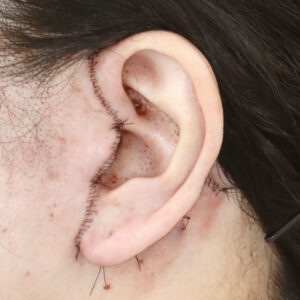 新宿ラクル美容外科クリニック　山本厚志　ナチュラルフェイスネックリフト　耳の傷痕　　手術直後　　１２月１２日