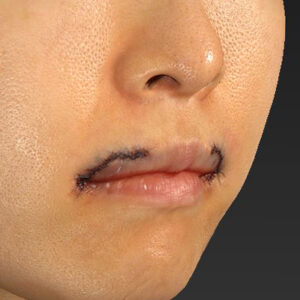 新宿ラクル美容外科クリニック　山本厚志　「外側人中短縮術（上口唇挙上術）修正 + 口角挙上（スマイルリフト）修正」　手術直後　１２月１３日