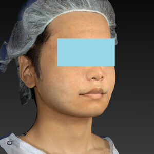 新宿ラクル美容外科クリニック　山本厚志　「アルテミスリフト＋ライポライフ脂肪吸引（メーラーファット+ジョールファット）」　手術直後　１２月１５日