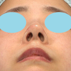 「鼻孔縁下降術」　新宿ラクル美容外科クリニック　山本厚志　３０代女性　手術後１週間目　１月３日