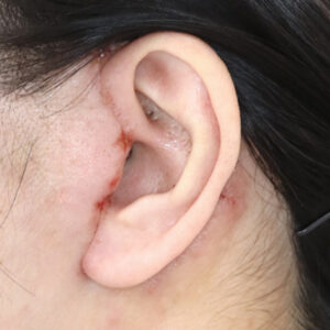 新宿ラクル美容外科クリニック　山本厚志　ナチュラルフェイスネックリフト　耳の傷痕　　手術後１週間目　　１２月１２日