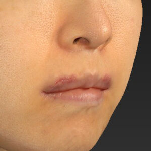 新宿ラクル美容外科クリニック　山本厚志　「外側人中短縮術（上口唇挙上術）修正 + 口角挙上（スマイルリフト）修正」　手術後１週間目　１２月１３日