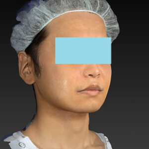 新宿ラクル美容外科クリニック　山本厚志　「アルテミスリフト＋ライポライフ脂肪吸引（メーラーファット+ジョールファット）」　手術後１週間目　１２月１５日