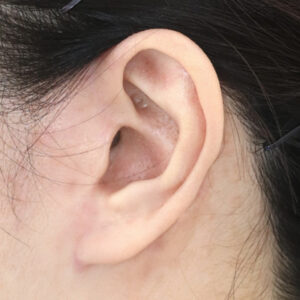 新宿ラクル美容外科クリニック　山本厚志　ナチュラルフェイスネックリフト　耳の傷痕　　手術後１２ヶ月目　　１２月１２日