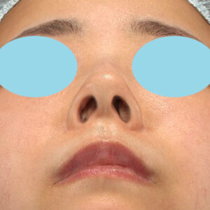 「鼻孔縁下降術」　新宿ラクル美容外科クリニック　山本厚志　３０代女性　手術後１ヶ月目　１月３日