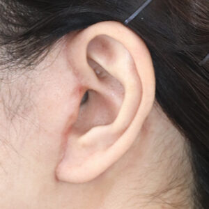 新宿ラクル美容外科クリニック　山本厚志　ナチュラルフェイスネックリフト　耳の傷痕　　手術後１ヶ月目　　１２月１２日