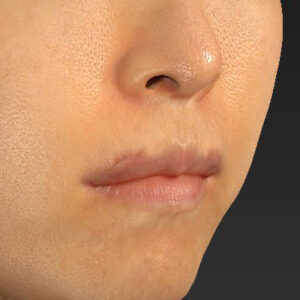 新宿ラクル美容外科クリニック　山本厚志　「外側人中短縮術（上口唇挙上術）修正 + 口角挙上（スマイルリフト）修正」　手術後１ヶ月目　１２月１３日