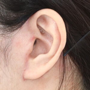 新宿ラクル美容外科クリニック　山本厚志　ナチュラルフェイスネックリフト　耳の傷痕　　手術後２ヶ月目　　１２月１２日