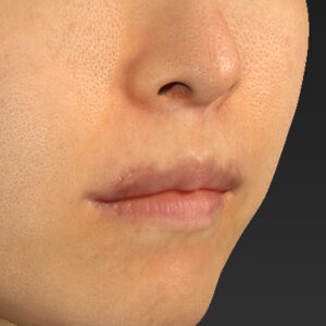 新宿ラクル美容外科クリニック　山本厚志　「外側人中短縮術（上口唇挙上術）修正 + 口角挙上（スマイルリフト）修正」　手術後２ヶ月目　１２月１３日