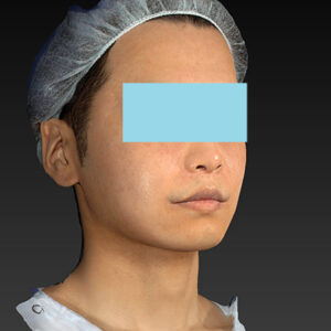 新宿ラクル美容外科クリニック　山本厚志　「アルテミスリフト＋ライポライフ脂肪吸引（メーラーファット+ジョールファット）」　手術後３ヶ月目　１２月１５日