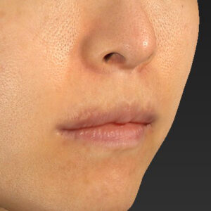 新宿ラクル美容外科クリニック　山本厚志　「外側人中短縮術（上口唇挙上術）修正 + 口角挙上（スマイルリフト）修正」　手術後３ヶ月目　１２月１３日