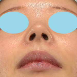 新宿ラクル美容外科クリニック　山本厚志　「小鼻縮小+α法」　手術後３ヶ月目　１月１４日