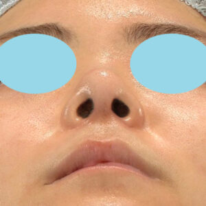 「鼻中隔延長修正＋耳介軟骨移植修正＋鼻尖形成修正＋小鼻縮小＋α法修正＋鼻柱下降＋真皮脂肪移植（鼻尖）」　新宿ラクル美容外科クリニック　２０代女性　手術後６ヶ月目　３月６日