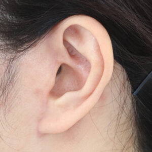 新宿ラクル美容外科クリニック　山本厚志　ナチュラルフェイスネックリフト　耳の傷痕　　手術後６ヶ月目　　１２月１２日