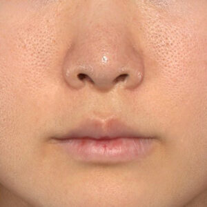 新宿ラクル美容外科クリニック　山本厚志　「猫手術（鼻唇角形成術）+ 貴族手術（鼻翼基部プロテーゼ）」　手術後６ヶ月目　４月５日