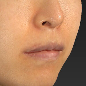 新宿ラクル美容外科クリニック　山本厚志　「外側人中短縮術（上口唇挙上術）修正 + 口角挙上（スマイルリフト）修正」　手術後６ヶ月目　４月８日