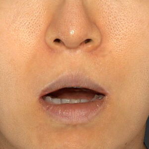 新宿ラクル美容外科クリニック　山本厚志　「外側人中短縮術（上口唇挙上術）修正 + 口角挙上（スマイルリフト）修正」　手術前　１２月１３日