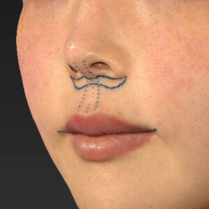 新宿ラクル美容外科クリニック　山本厚志　「人中短縮術（リップリフト）＋口角挙上（スマイルリップ）」　デザイン　１２月８日