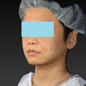 新宿ラクル美容外科クリニック　山本厚志　「アルテミスリフト＋ライポライフ脂肪吸引（メーラーファット+ジョールファット）」　デザイン　１２月１５日