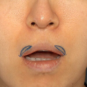 新宿ラクル美容外科クリニック　山本厚志　「外側人中短縮術（上口唇挙上術）修正 + 口角挙上（スマイルリフト）修正」　デザイン　１２月１３日