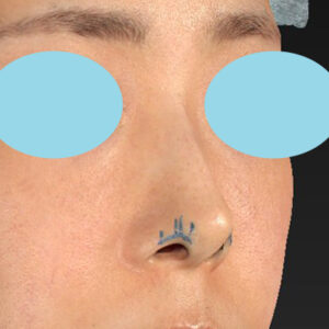 「鼻孔縁下降術」　新宿ラクル美容外科クリニック　山本厚志　３０代女性　デザイン　１月３日