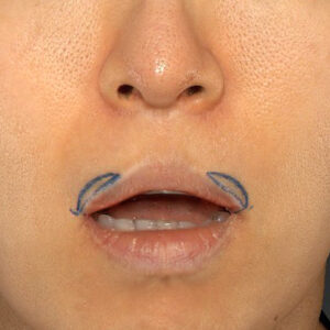 新宿ラクル美容外科クリニック　山本厚志　「外側人中短縮術（上口唇挙上術）修正 + 口角挙上（スマイルリフト）修正」　デザイン　４月８日