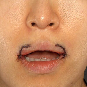新宿ラクル美容外科クリニック　山本厚志　「外側人中短縮術（上口唇挙上術）修正 + 口角挙上（スマイルリフト）修正」　手術直後　１２月１３日