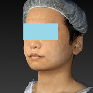 新宿ラクル美容外科クリニック　山本厚志　「アルテミスリフト＋ライポライフ脂肪吸引（メーラーファット+ジョールファット）」　手術直後　１２月１５日