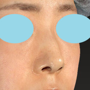 「鼻孔縁下降術」　新宿ラクル美容外科クリニック　山本厚志　３０代女性　手術直後　１月３日