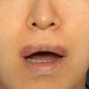 新宿ラクル美容外科クリニック　山本厚志　「外側人中短縮術（上口唇挙上術）修正 + 口角挙上（スマイルリフト）修正」　手術後１週間目　１２月１３日