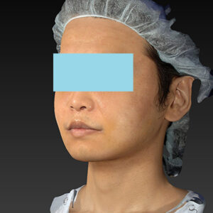 新宿ラクル美容外科クリニック　山本厚志　「アルテミスリフト＋ライポライフ脂肪吸引（メーラーファット+ジョールファット）」　手術後１週間目　１２月１５日