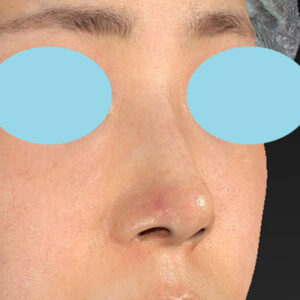 「鼻孔縁下降術」　新宿ラクル美容外科クリニック　山本厚志　３０代女性　手術後１週間目　１月３日