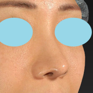 「鼻中隔延長（鼻中隔軟骨）＋耳介軟骨移植＋鼻尖形成＋真皮脂肪移植（鼻尖）＋猫手術」　新宿ラクル美容外科クリニック　３０代女性　手術後１２ヶ月目　１月１６日