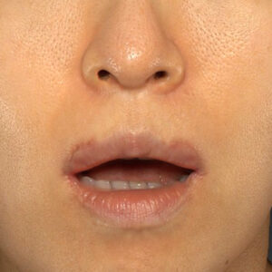 新宿ラクル美容外科クリニック　山本厚志　「外側人中短縮術（上口唇挙上術）修正 + 口角挙上（スマイルリフト）修正」　手術後１ヶ月目　１２月１３日