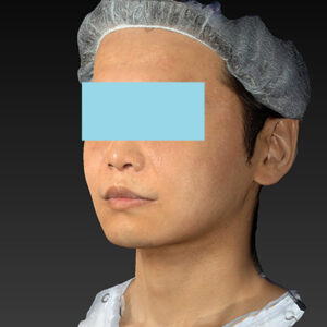 新宿ラクル美容外科クリニック　山本厚志　「アルテミスリフト＋ライポライフ脂肪吸引（メーラーファット+ジョールファット）」　手術後１ヶ月目　１２月１５日