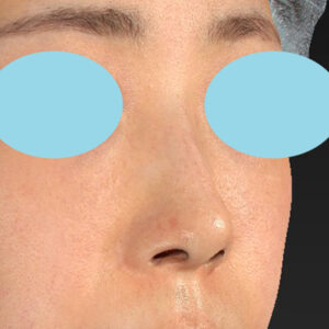 「鼻孔縁下降術」　新宿ラクル美容外科クリニック　山本厚志　３０代女性　手術後１ヶ月目　１月３日