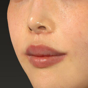 新宿ラクル美容外科クリニック　山本厚志　「人中短縮術（リップリフト）＋口角挙上（スマイルリップ）」　手術後２ヶ月目　１２月８日