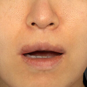 新宿ラクル美容外科クリニック　山本厚志　「外側人中短縮術（上口唇挙上術）修正 + 口角挙上（スマイルリフト）修正」　手術後２ヶ月目　１２月１３日