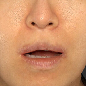 新宿ラクル美容外科クリニック　山本厚志　「外側人中短縮術（上口唇挙上術）修正 + 口角挙上（スマイルリフト）修正」　手術後３ヶ月目　１２月１３日