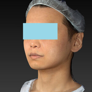 新宿ラクル美容外科クリニック　山本厚志　「アルテミスリフト＋ライポライフ脂肪吸引（メーラーファット+ジョールファット）」　手術後３ヶ月目　１２月１５日