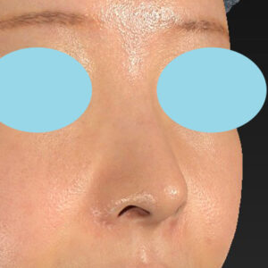 新宿ラクル美容外科クリニック　山本厚志　「小鼻縮小+α法」　手術後３ヶ月目　１月１４日