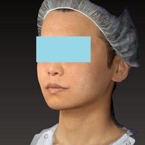 新宿ラクル美容外科クリニック　山本厚志　「アルテミスリフト＋ライポライフ脂肪吸引（メーラーファット+ジョールファット）」　手術後６ヶ月目　３月１４日