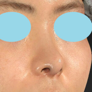 「鼻中隔延長修正＋耳介軟骨移植修正＋鼻尖形成修正＋小鼻縮小＋α法修正＋鼻柱下降＋真皮脂肪移植（鼻尖）」　新宿ラクル美容外科クリニック　２０代女性　手術後６ヶ月目　３月６日