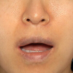 新宿ラクル美容外科クリニック　山本厚志　「外側人中短縮術（上口唇挙上術）修正 + 口角挙上（スマイルリフト）修正」　手術後６ヶ月目　４月８日